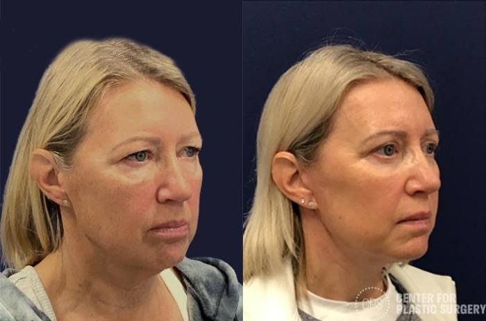 Facelift Case 195 Before & After Right Oblique | Chevy Chase & Annandale, Washington D.C. Metropolitan Area | Center for Plastic Surgery