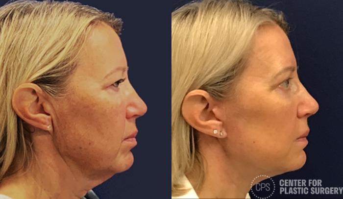 Facelift Case 195 Before & After Right Side | Chevy Chase & Annandale, Washington D.C. Metropolitan Area | Center for Plastic Surgery
