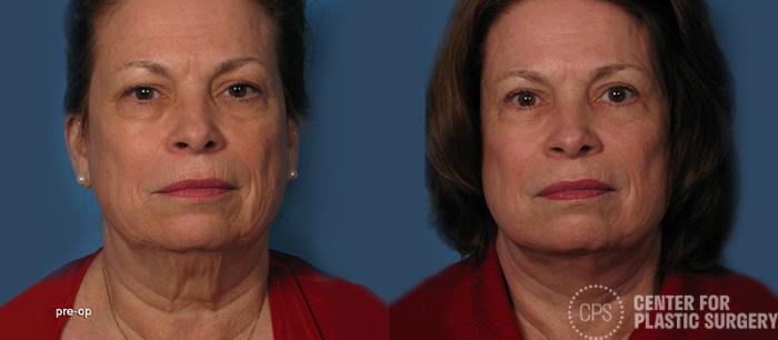 Neck Lift Case 2 Before & After Front | Chevy Chase & Annandale, Washington D.C. Metropolitan Area | Center for Plastic Surgery