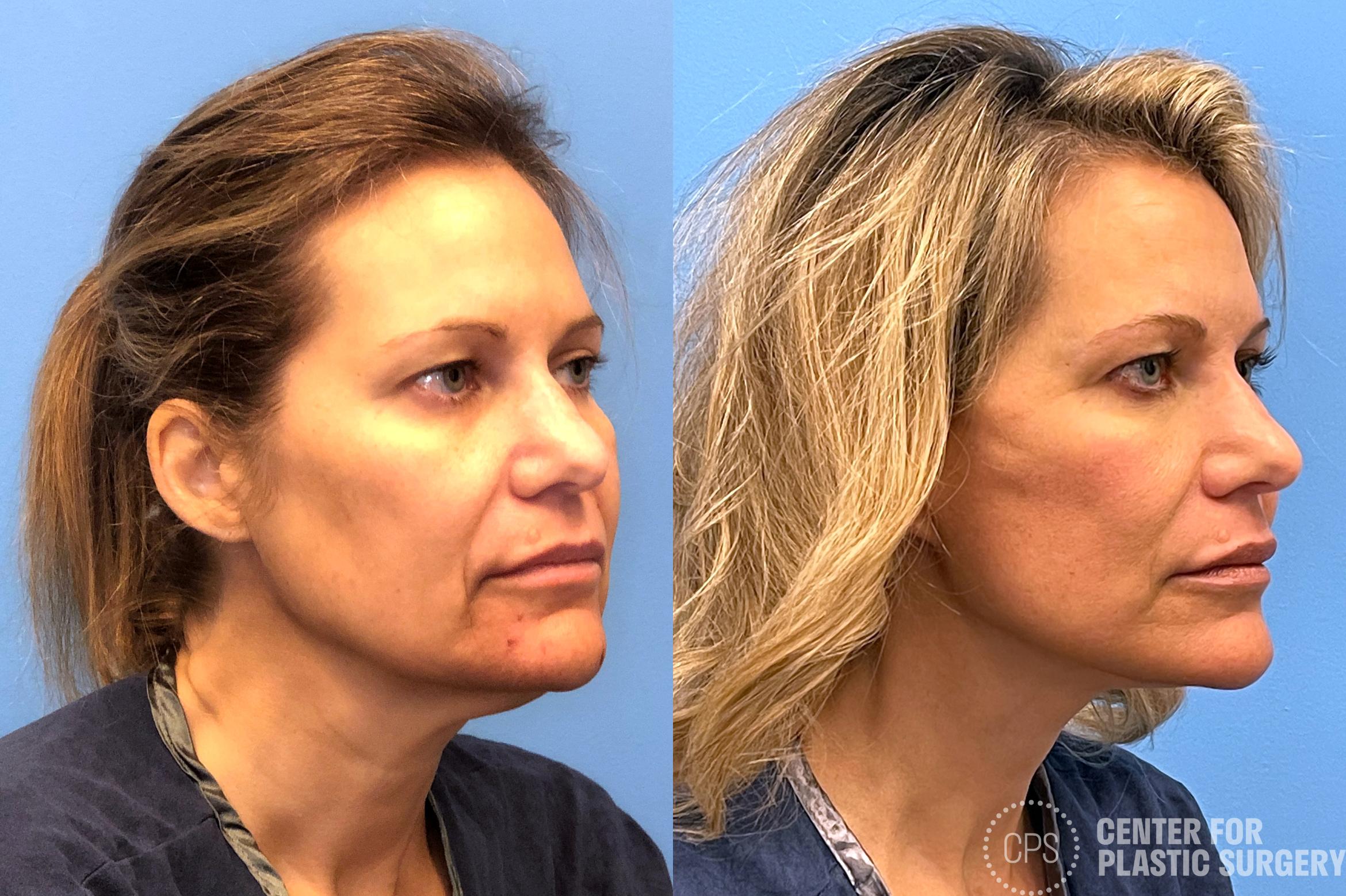 Facelift Case 202 Before & After Left Oblique | Annandale, Washington D.C. Metropolitan Area | Center for Plastic Surgery