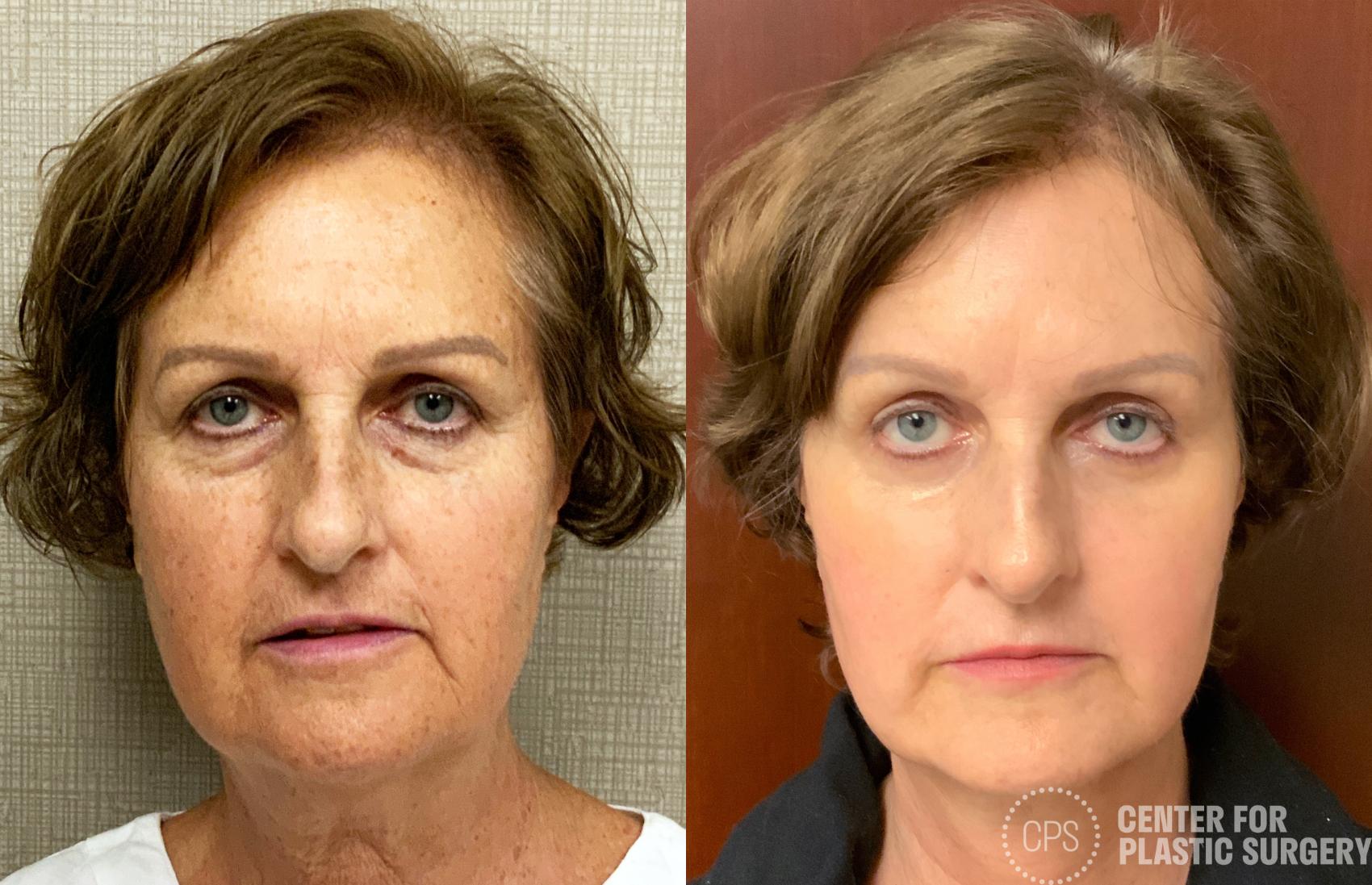 Facelift Case 207 Before & After Front | Chevy Chase & Annandale, Washington D.C. Metropolitan Area | Center for Plastic Surgery