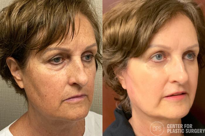 FACE360 Case 207 Before & After Right Oblique | Chevy Chase & Annandale, Washington D.C. Metropolitan Area | Center for Plastic Surgery