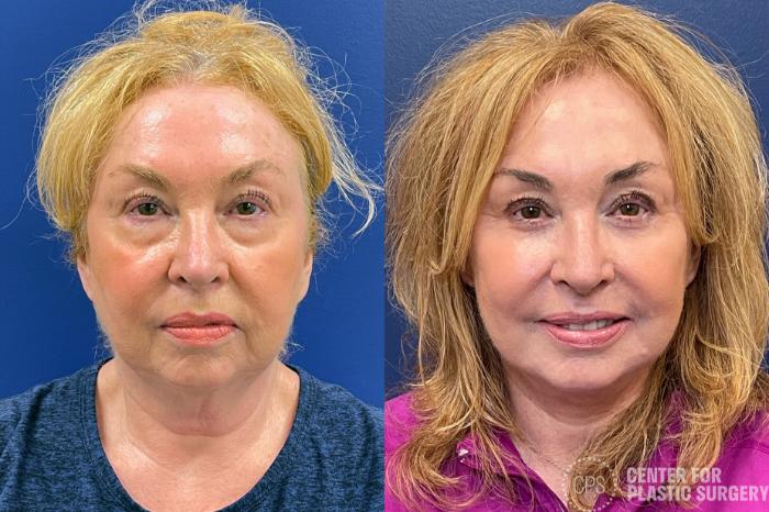 FACE360 Case 209 Before & After Front | Chevy Chase & Annandale, Washington D.C. Metropolitan Area | Center for Plastic Surgery