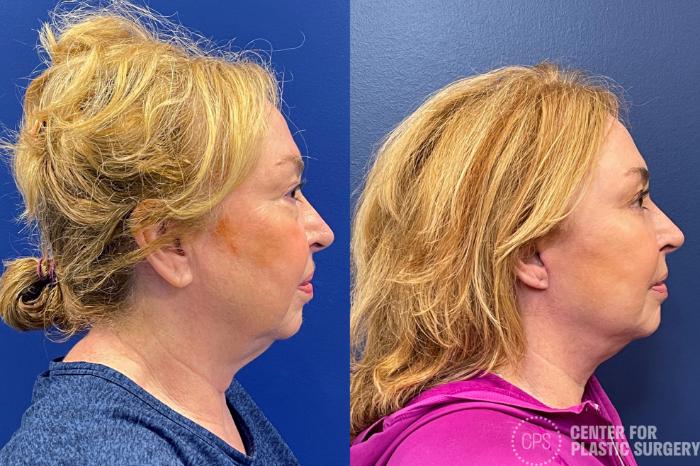 Facelift Case 209 Before & After Left Side | Chevy Chase & Annandale, Washington D.C. Metropolitan Area | Center for Plastic Surgery