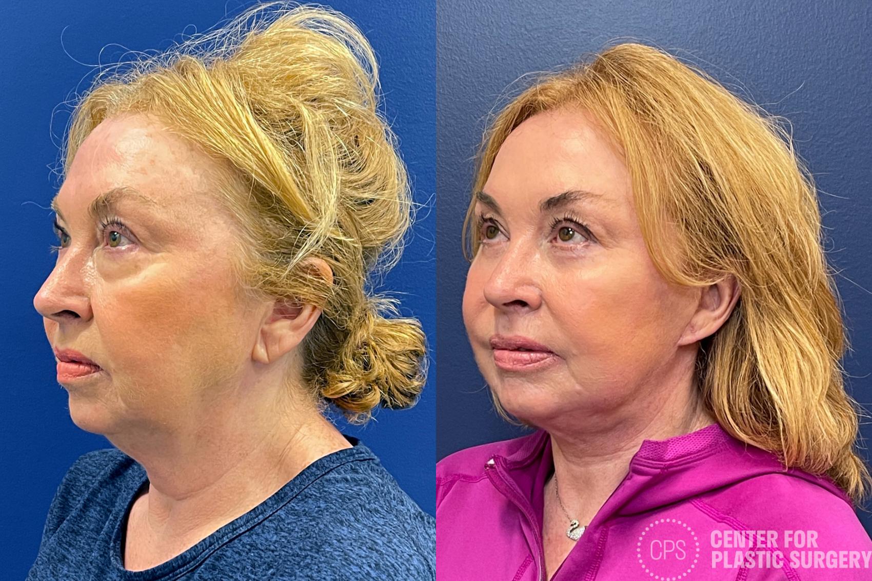 Facelift Case 209 Before & After Right Oblique | Annandale, Washington D.C. Metropolitan Area | Center for Plastic Surgery