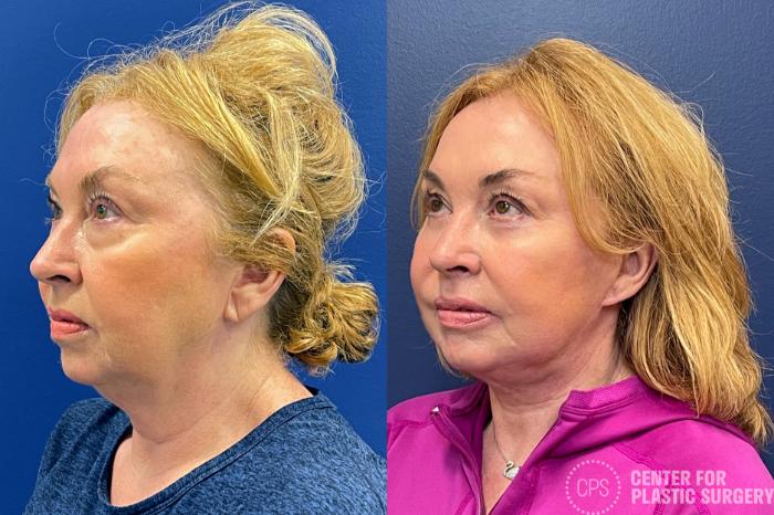 FACE360 Case 209 Before & After Right Oblique | Chevy Chase & Annandale, Washington D.C. Metropolitan Area | Center for Plastic Surgery