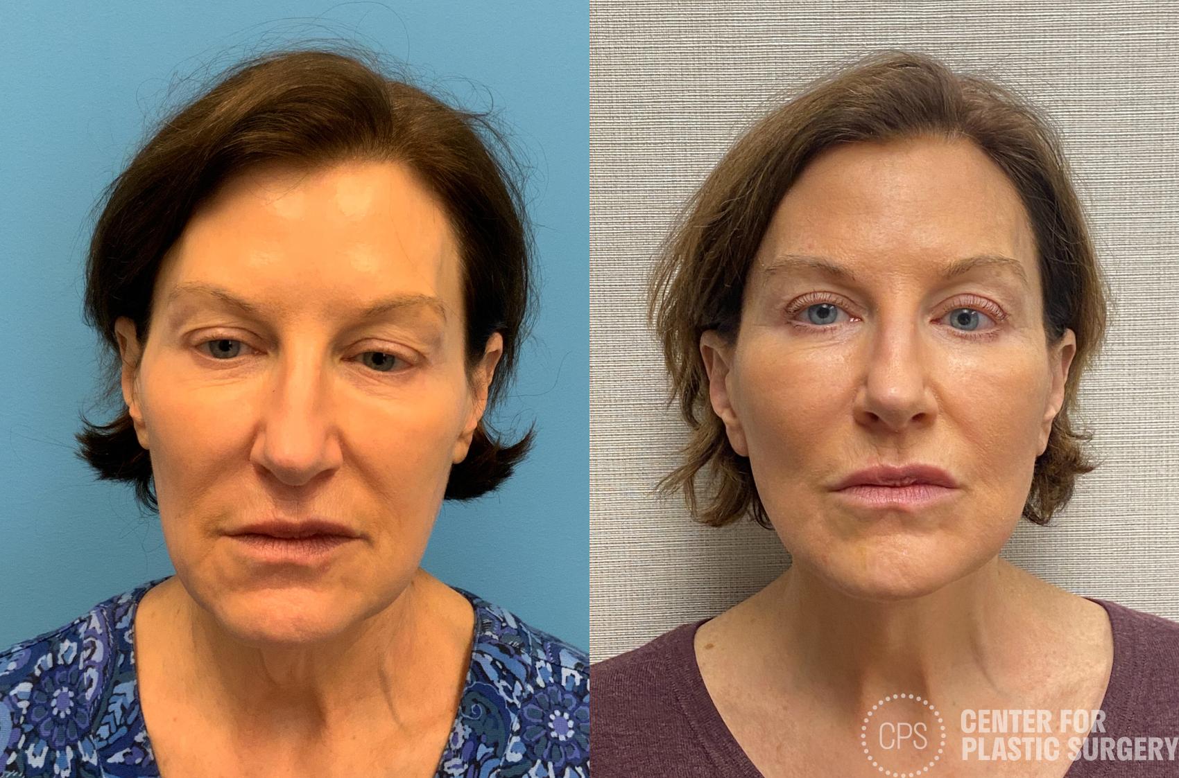 Facelift Case 213 Before & After Front | Annandale, Washington D.C. Metropolitan Area | Center for Plastic Surgery