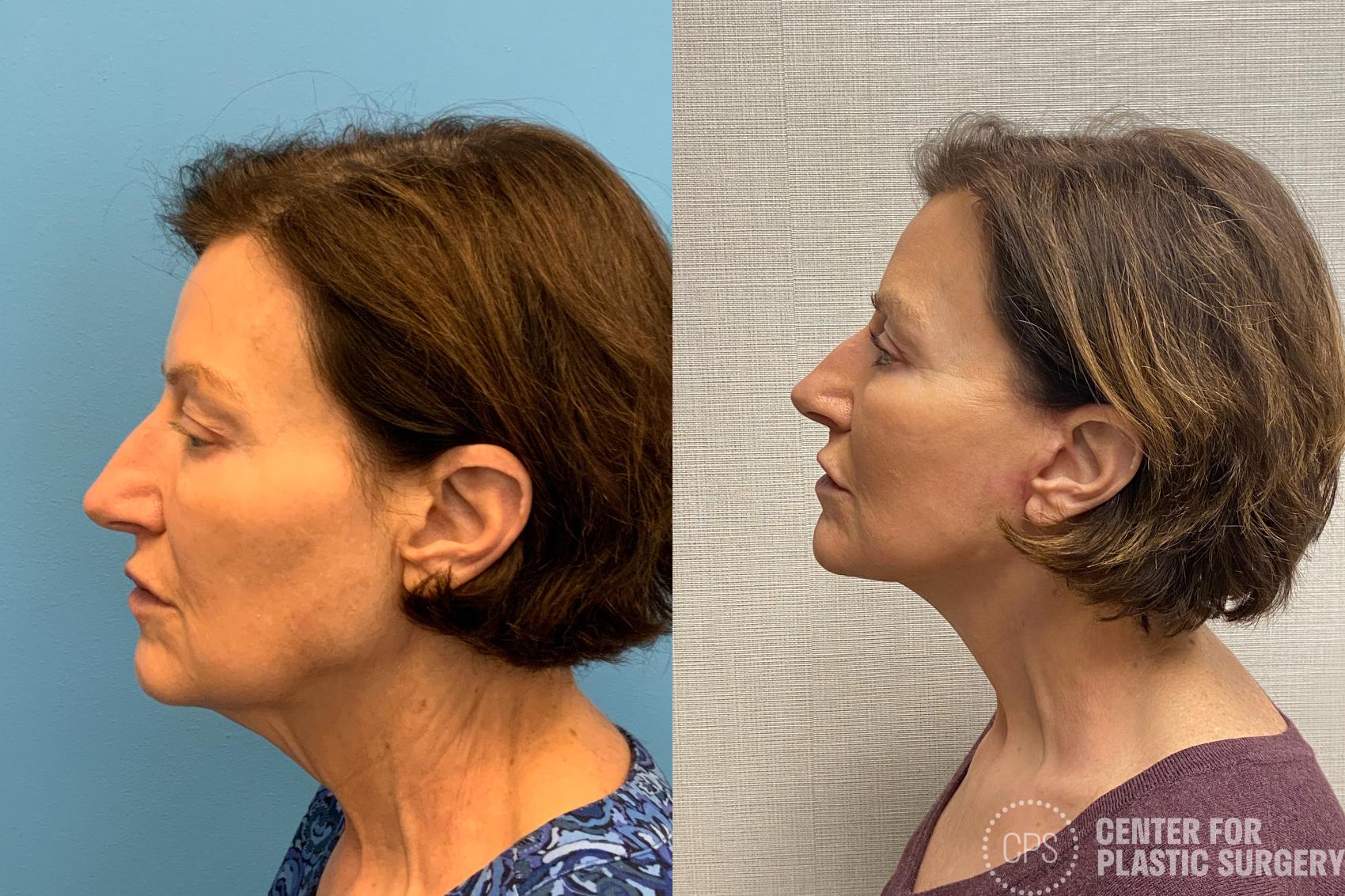 Facelift Case 213 Before & After Left Side | Annandale, Washington D.C. Metropolitan Area | Center for Plastic Surgery