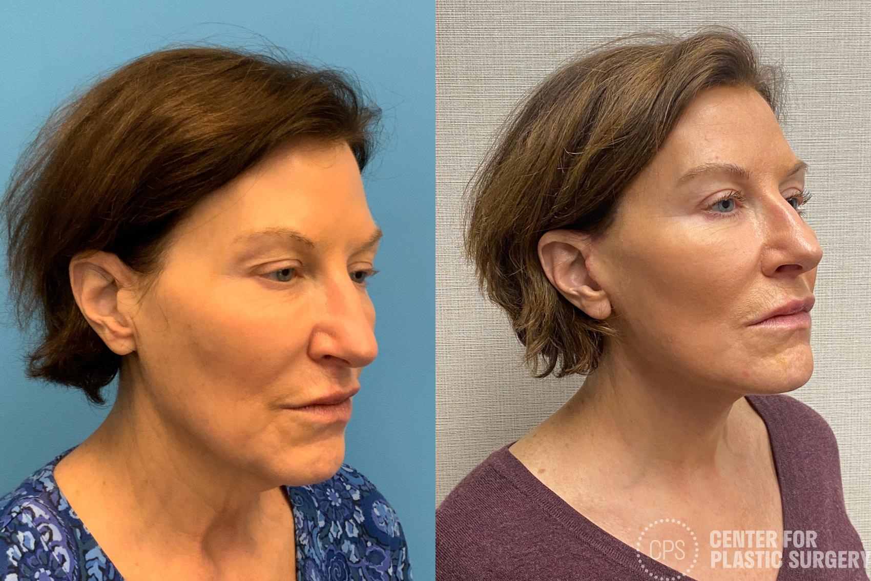 Facelift Case 213 Before & After Right Oblique | Annandale, Washington D.C. Metropolitan Area | Center for Plastic Surgery