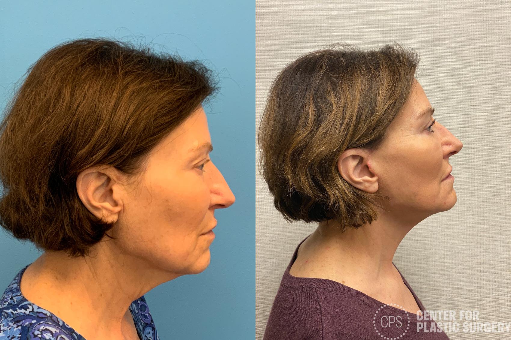 Facelift Case 213 Before & After Right Side | Annandale, Washington D.C. Metropolitan Area | Center for Plastic Surgery