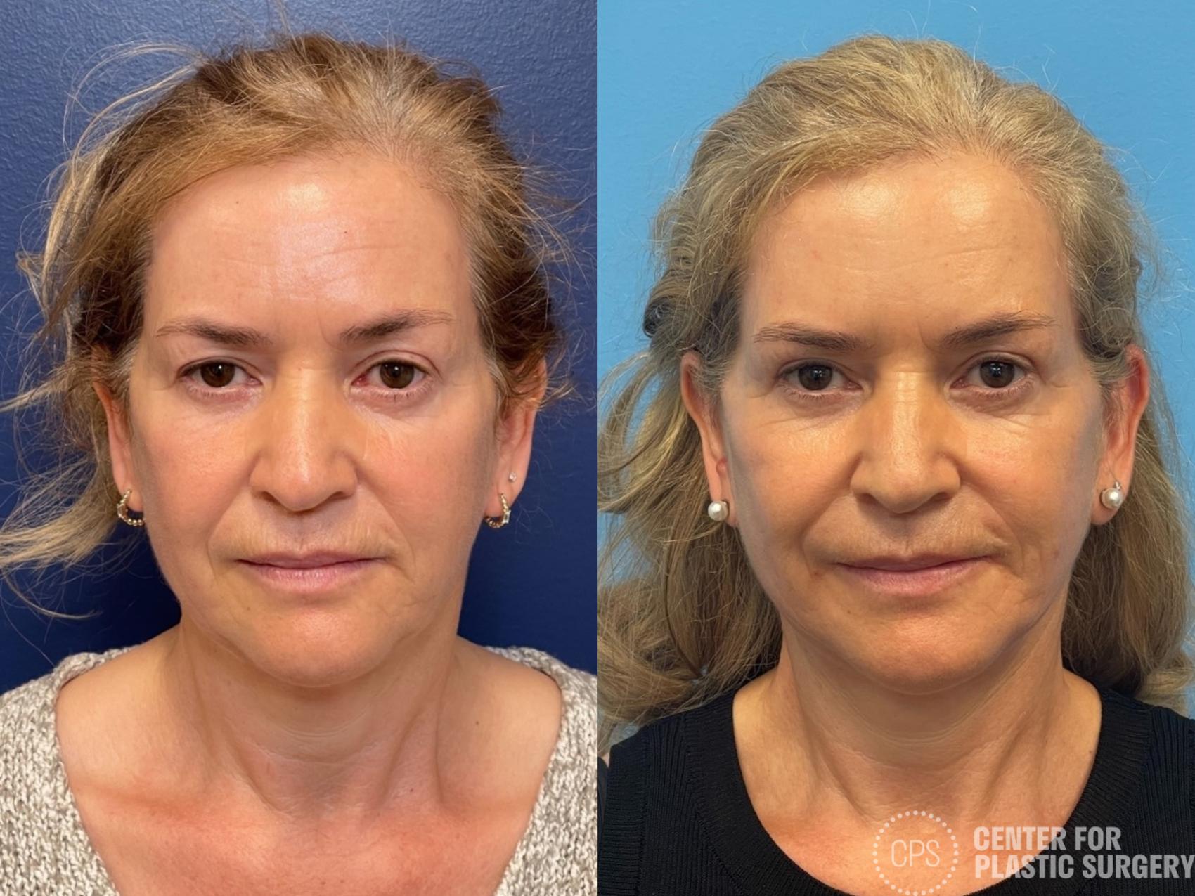Facelift Case 292 Before & After Front | Chevy Chase & Annandale, Washington D.C. Metropolitan Area | Center for Plastic Surgery