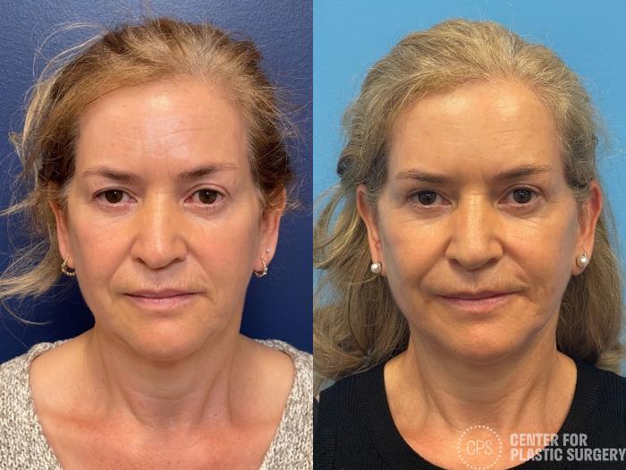 Neck Lift Case 292 Before & After Front | Chevy Chase & Annandale, Washington D.C. Metropolitan Area | Center for Plastic Surgery
