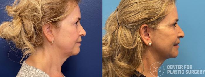 Facelift Case 292 Before & After Right Side | Chevy Chase & Annandale, Washington D.C. Metropolitan Area | Center for Plastic Surgery