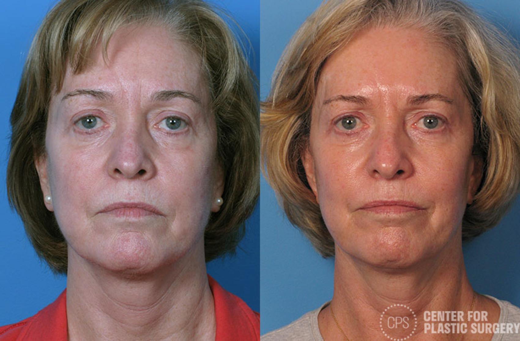 Facelift Case 3 Before & After Front | Annandale, Washington D.C. Metropolitan Area | Center for Plastic Surgery