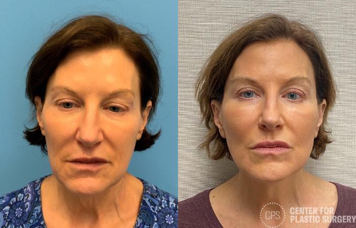Neck Lift Case 328 Before & After Front | Chevy Chase & Annandale, Washington D.C. Metropolitan Area | Center for Plastic Surgery