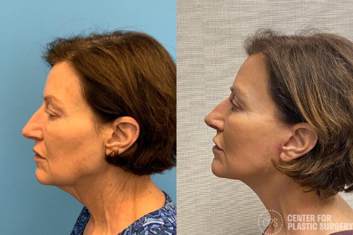 Facelift Case 328 Before & After Left Side | Chevy Chase & Annandale, Washington D.C. Metropolitan Area | Center for Plastic Surgery