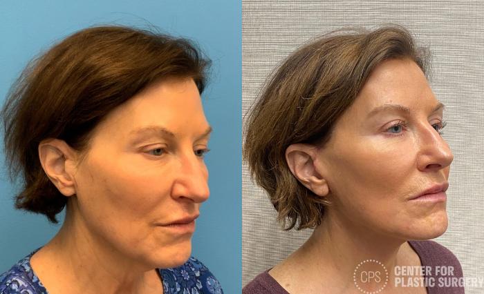 Facelift Case 328 Before & After Right Oblique | Chevy Chase & Annandale, Washington D.C. Metropolitan Area | Center for Plastic Surgery