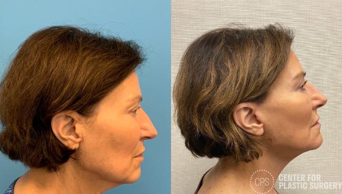 Eyelid Surgery Case 328 Before & After Right Side | Chevy Chase & Annandale, Washington D.C. Metropolitan Area | Center for Plastic Surgery