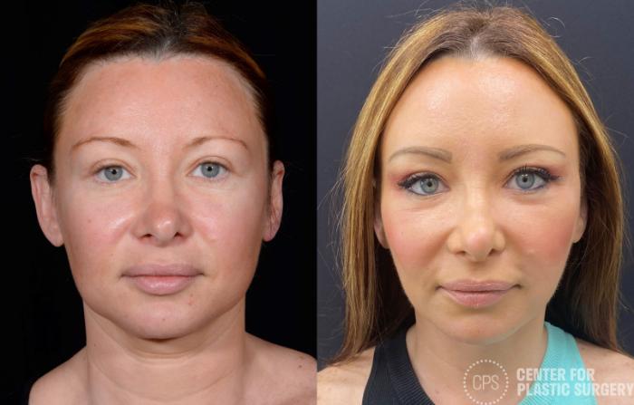Eyelid Surgery Case 355 Before & After Front | Chevy Chase & Annandale, Washington D.C. Metropolitan Area | Center for Plastic Surgery