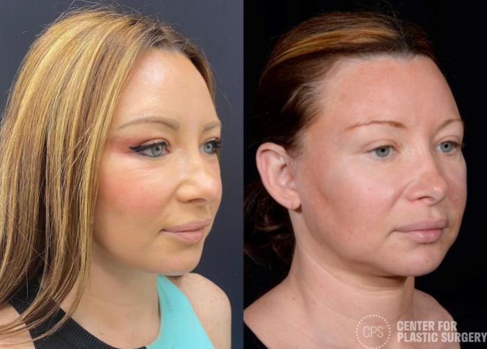 Eyelid Surgery Case 355 Before & After Right Oblique | Chevy Chase & Annandale, Washington D.C. Metropolitan Area | Center for Plastic Surgery
