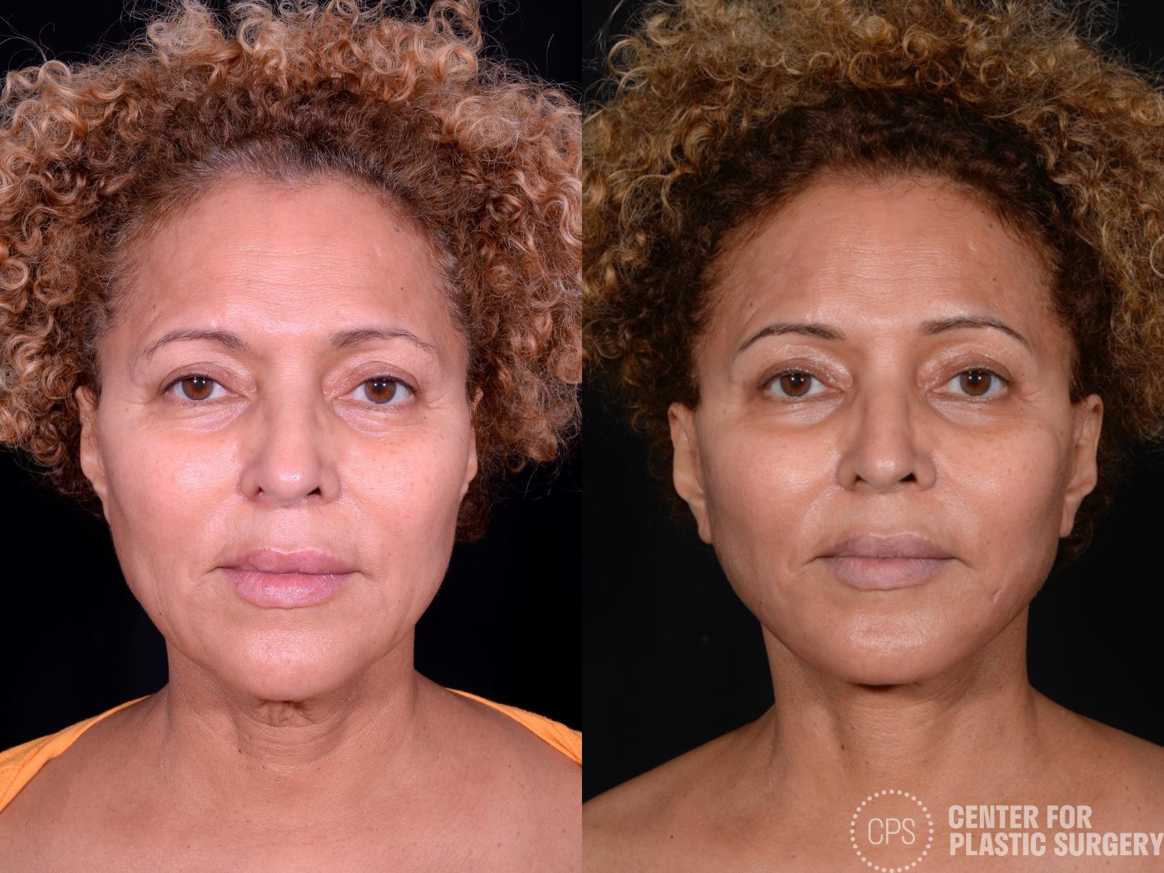 Facelift Case 360 Before & After Front | Chevy Chase & Annandale, Washington D.C. Metropolitan Area | Center for Plastic Surgery