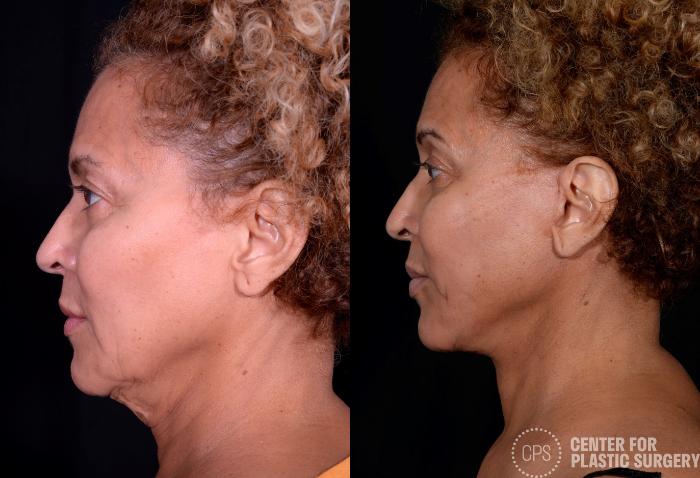 Neck Lift Case 360 Before & After Left Side | Chevy Chase & Annandale, Washington D.C. Metropolitan Area | Center for Plastic Surgery