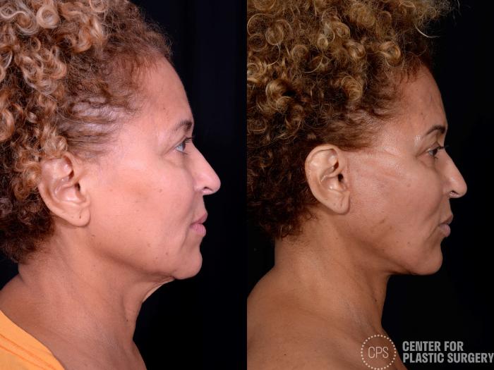 Neck Lift Case 360 Before & After Right Side | Chevy Chase & Annandale, Washington D.C. Metropolitan Area | Center for Plastic Surgery