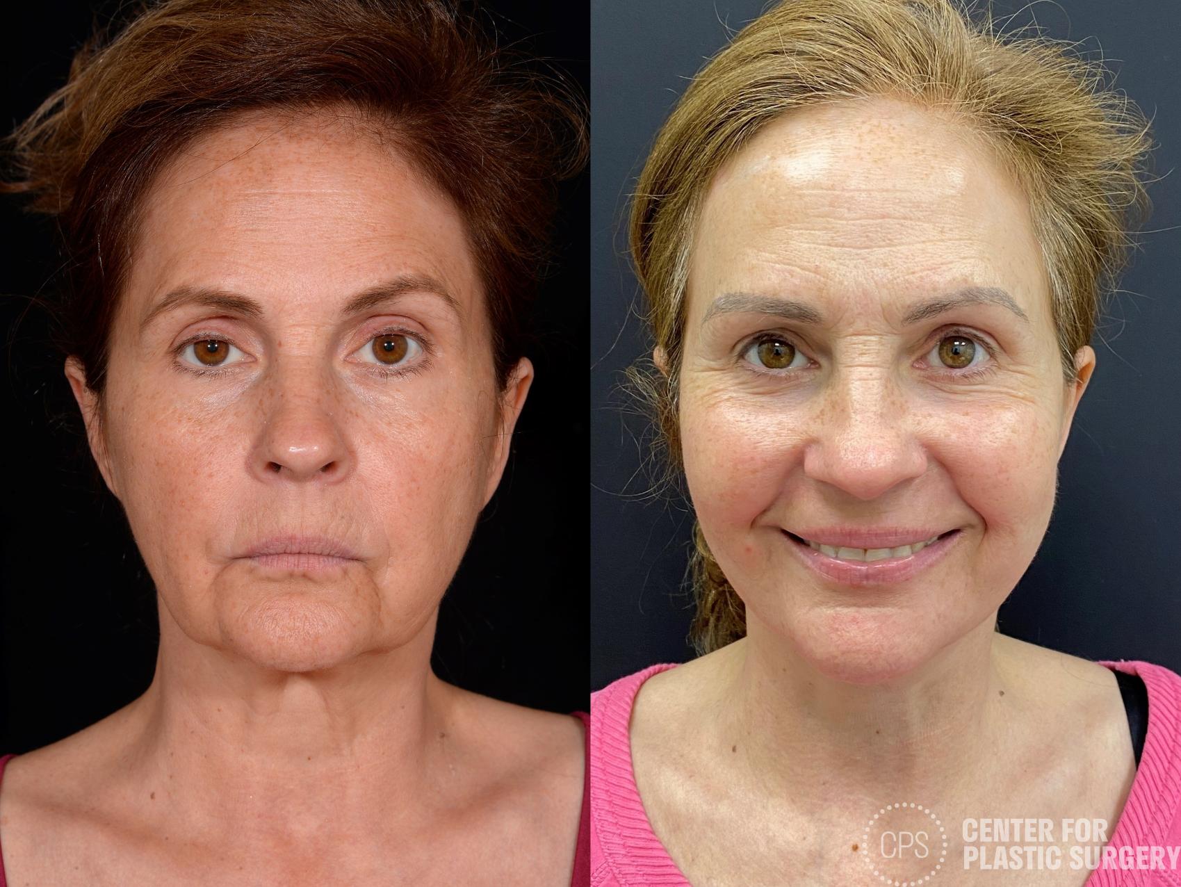 Facelift Case 361 Before & After Front | Chevy Chase & Annandale, Washington D.C. Metropolitan Area | Center for Plastic Surgery
