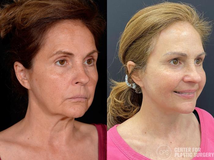 Eyelid Surgery Case 361 Before & After Right Oblique | Chevy Chase & Annandale, Washington D.C. Metropolitan Area | Center for Plastic Surgery