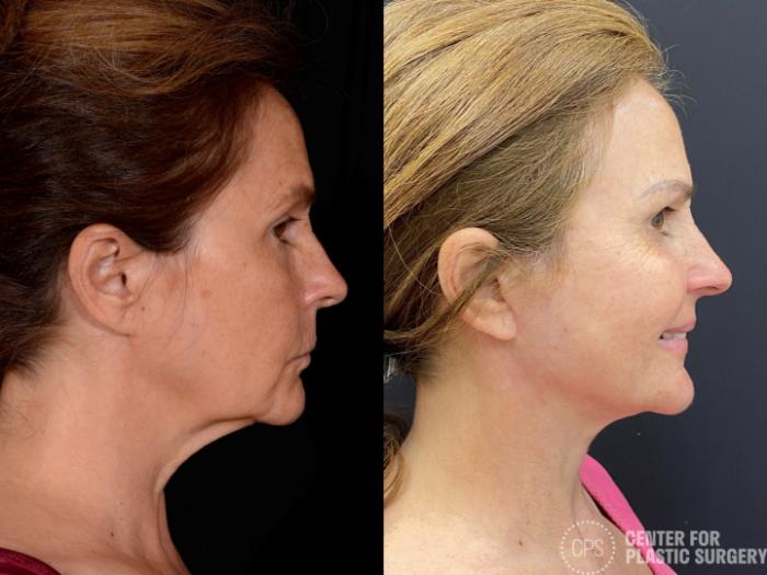 Facelift Case 361 Before & After Right Side | Chevy Chase & Annandale, Washington D.C. Metropolitan Area | Center for Plastic Surgery