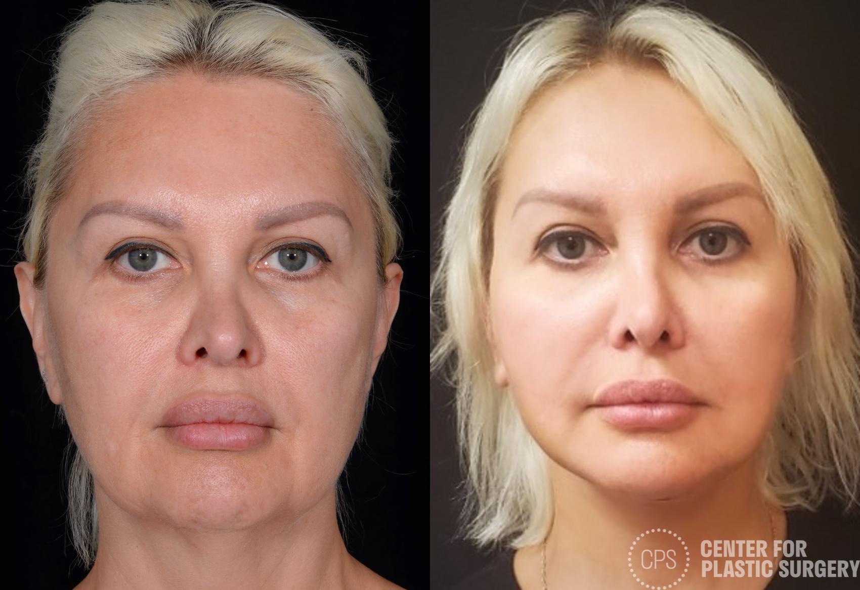 Facelift Case 362 Before & After Front | Chevy Chase & Annandale, Washington D.C. Metropolitan Area | Center for Plastic Surgery