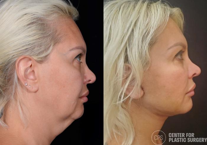 Facelift Case 362 Before & After Right Side | Chevy Chase & Annandale, Washington D.C. Metropolitan Area | Center for Plastic Surgery