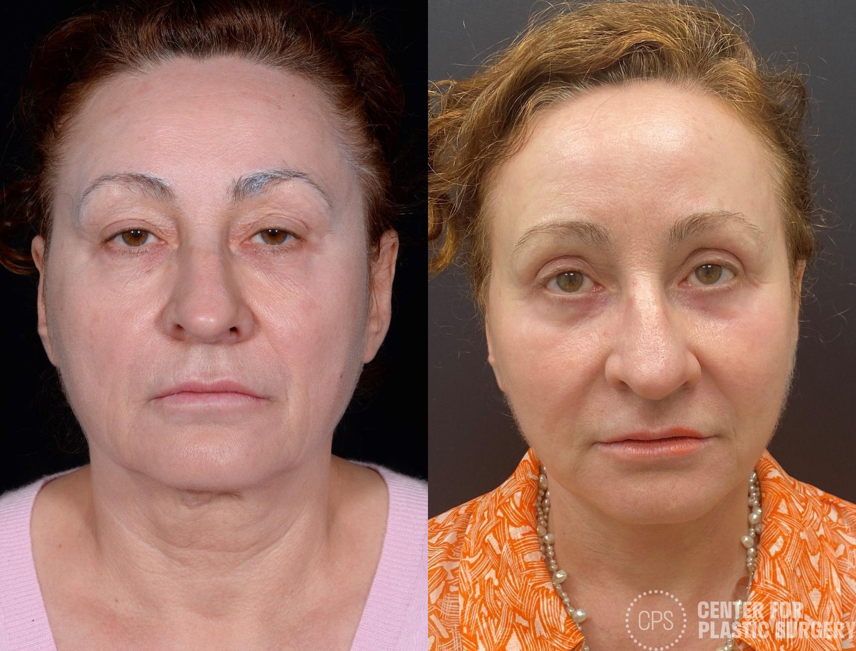 Eyelid Surgery Case 363 Before & After Front | Chevy Chase & Annandale, Washington D.C. Metropolitan Area | Center for Plastic Surgery