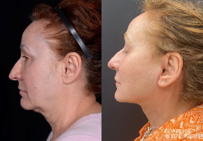 Facelift Case 363 Before & After Left Side | Chevy Chase & Annandale, Washington D.C. Metropolitan Area | Center for Plastic Surgery