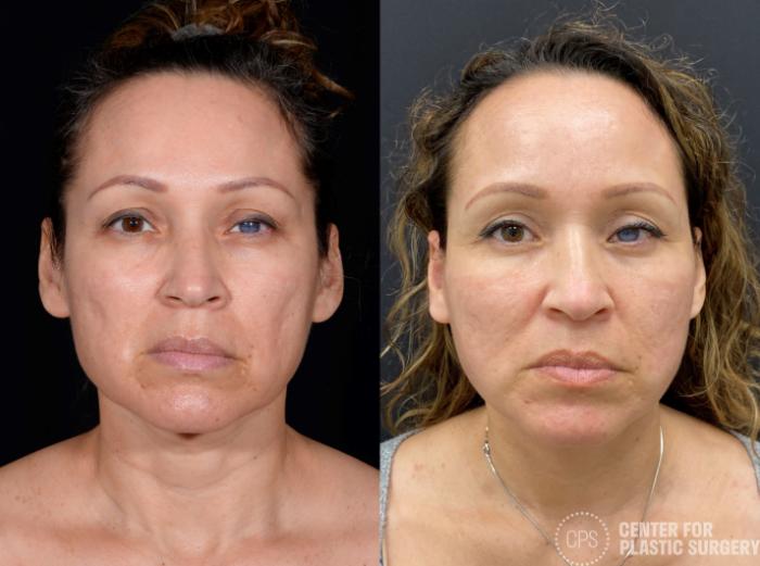 Facelift Case 364 Before & After Front | Chevy Chase & Annandale, Washington D.C. Metropolitan Area | Center for Plastic Surgery