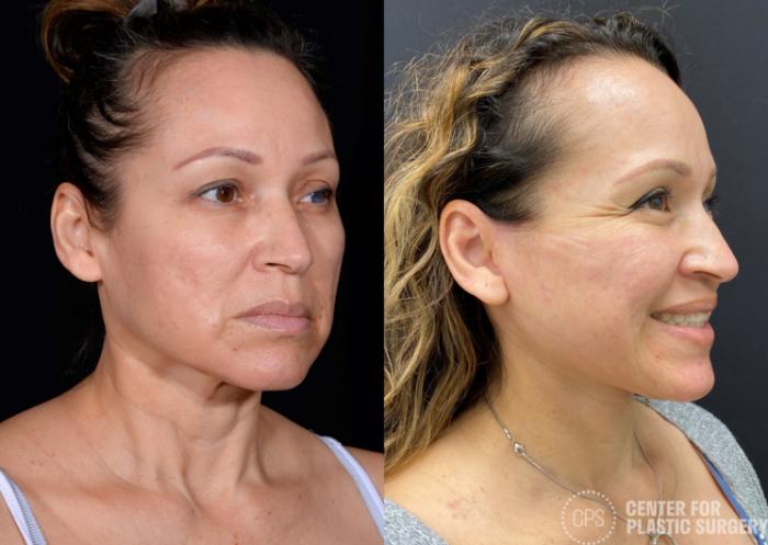 Facelift Case 364 Before & After Right Oblique | Chevy Chase & Annandale, Washington D.C. Metropolitan Area | Center for Plastic Surgery