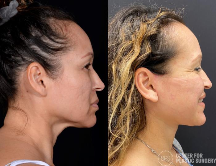 Facelift Case 364 Before & After Right Side | Chevy Chase & Annandale, Washington D.C. Metropolitan Area | Center for Plastic Surgery