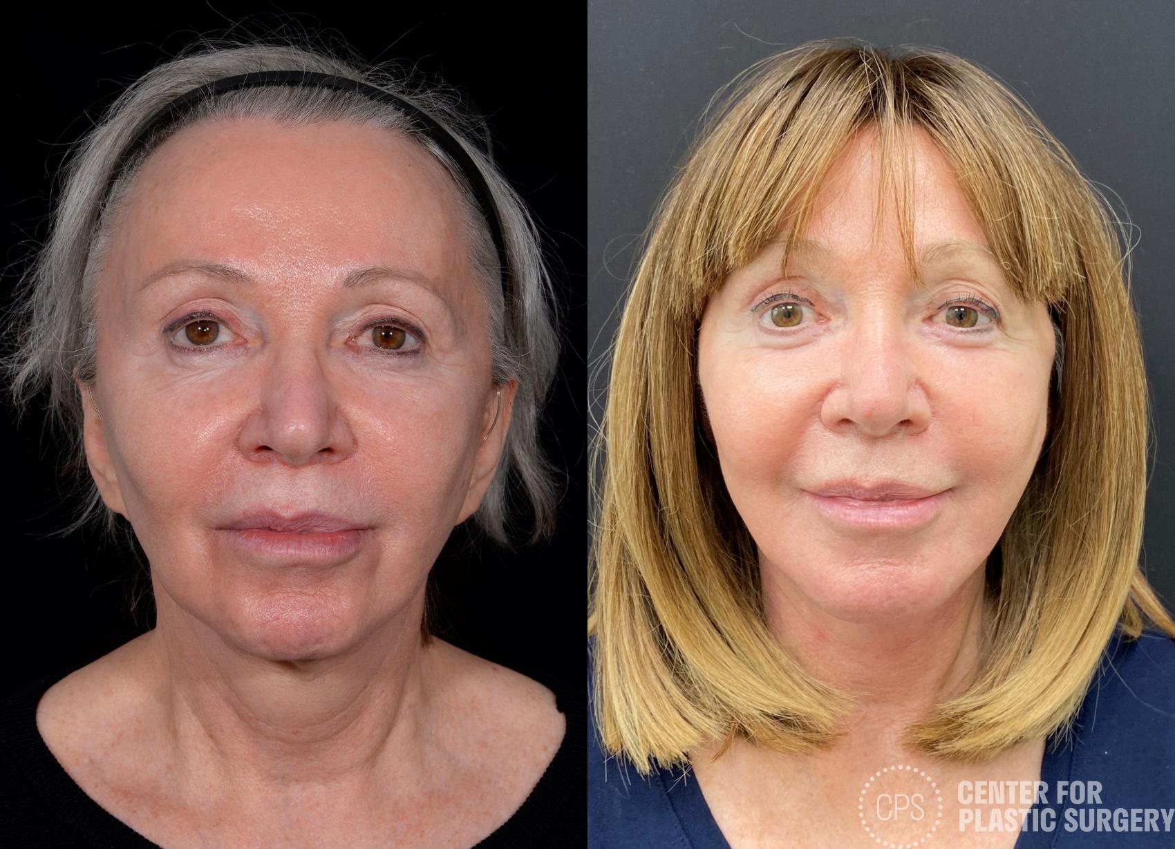 Facelift Case 365 Before & After Front | Chevy Chase & Annandale, Washington D.C. Metropolitan Area | Center for Plastic Surgery