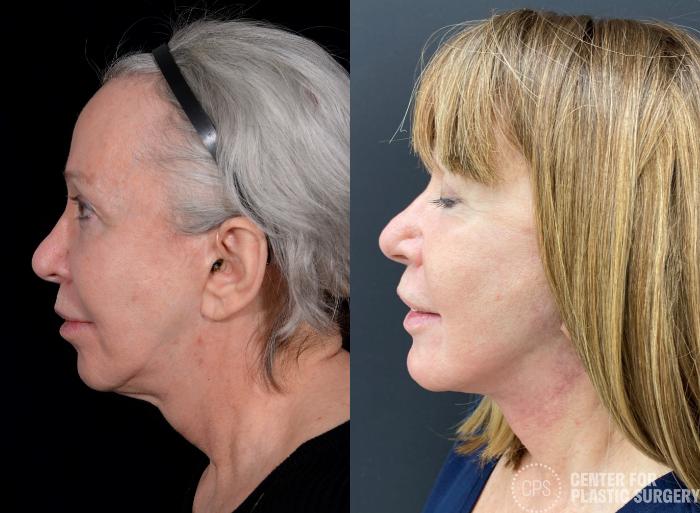 Neck Lift Case 365 Before & After Left Side | Chevy Chase & Annandale, Washington D.C. Metropolitan Area | Center for Plastic Surgery