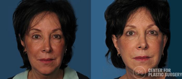 Facelift Case 4 Before & After Front | Chevy Chase & Annandale, Washington D.C. Metropolitan Area | Center for Plastic Surgery