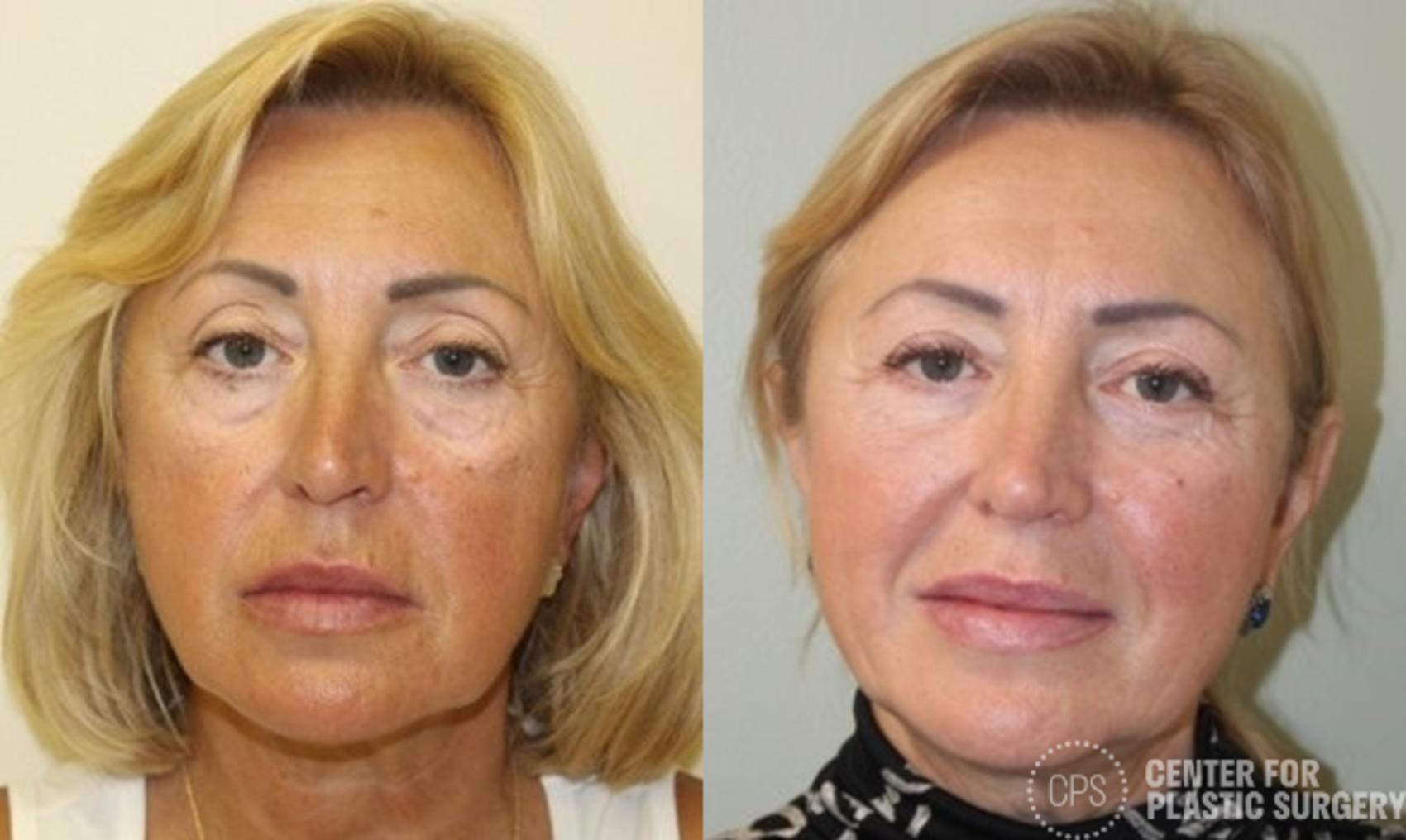 Facelift Case 401 Before & After Front | Chevy Chase & Annandale, Washington D.C. Metropolitan Area | Center for Plastic Surgery