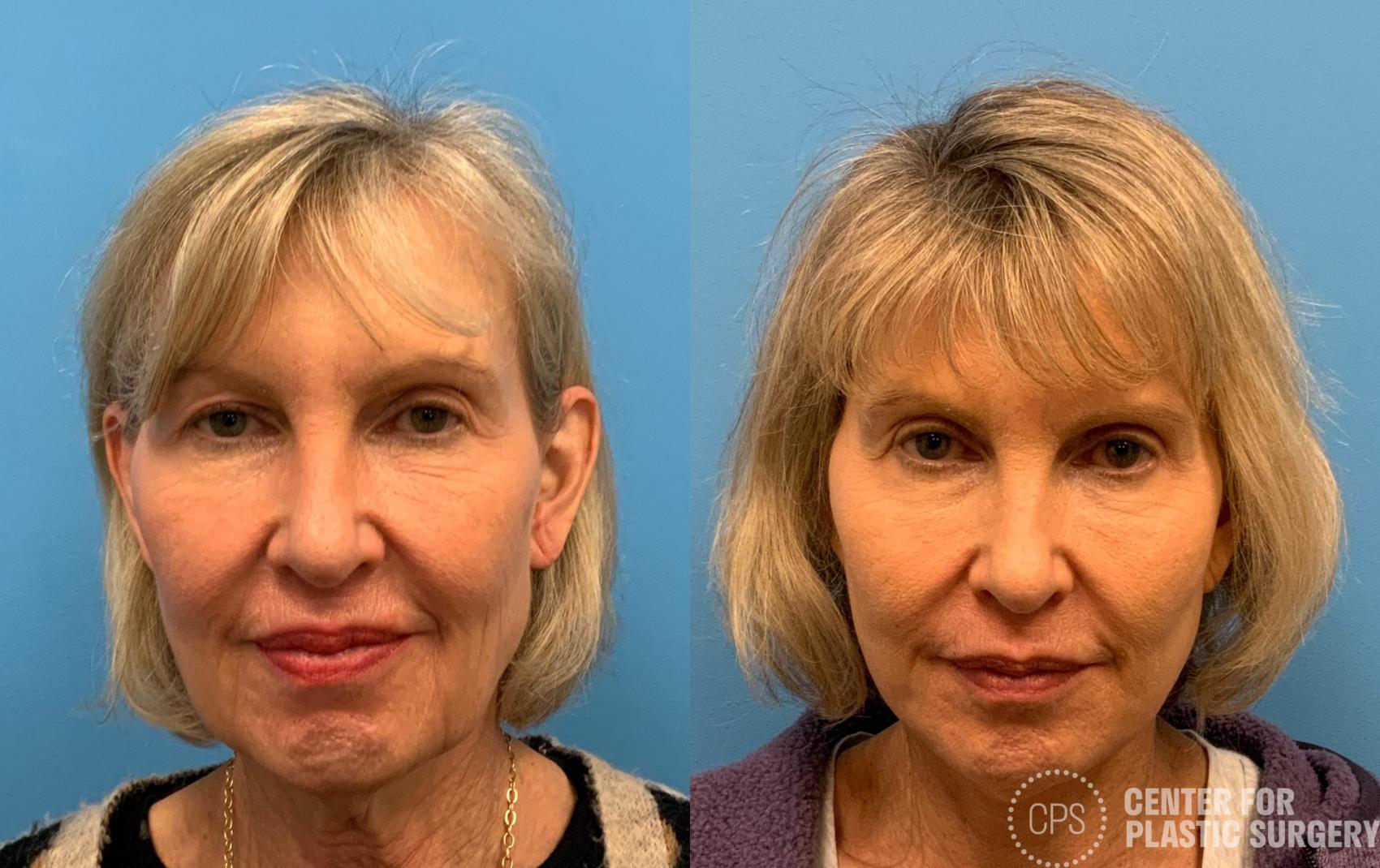 Facelift Case 405 Before & After Front | Chevy Chase & Annandale, Washington D.C. Metropolitan Area | Center for Plastic Surgery