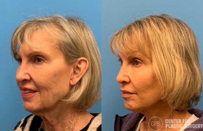Eyelid Surgery Case 405 Before & After Left Oblique | Chevy Chase & Annandale, Washington D.C. Metropolitan Area | Center for Plastic Surgery