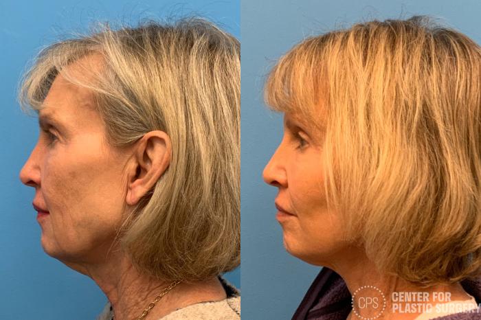Facelift Case 405 Before & After Left Side | Chevy Chase & Annandale, Washington D.C. Metropolitan Area | Center for Plastic Surgery