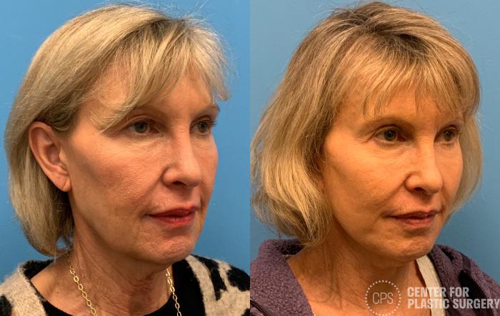 Facelift Case 405 Before & After Right Oblique | Chevy Chase & Annandale, Washington D.C. Metropolitan Area | Center for Plastic Surgery