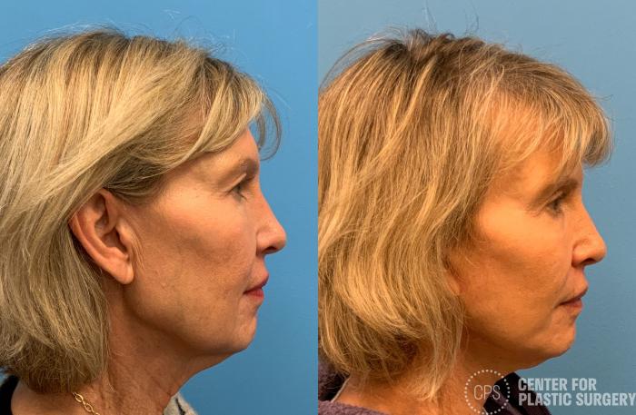 Neck Lift Case 405 Before & After Right Side | Chevy Chase & Annandale, Washington D.C. Metropolitan Area | Center for Plastic Surgery