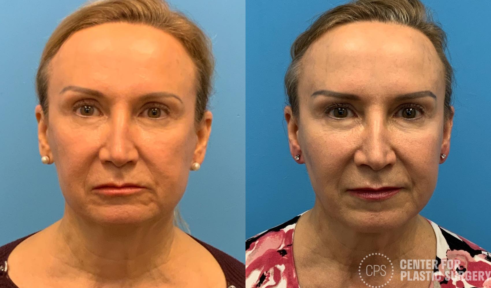 Facelift Case 408 Before & After Front | Chevy Chase & Annandale, Washington D.C. Metropolitan Area | Center for Plastic Surgery