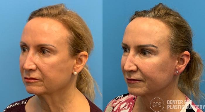 Facelift Case 408 Before & After Left Oblique | Chevy Chase & Annandale, Washington D.C. Metropolitan Area | Center for Plastic Surgery