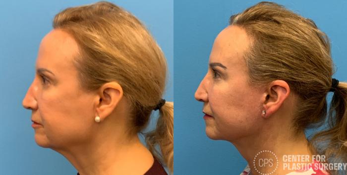 Facelift Case 408 Before & After Left Side | Chevy Chase & Annandale, Washington D.C. Metropolitan Area | Center for Plastic Surgery