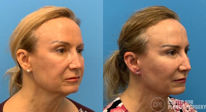 Facelift Case 408 Before & After Right Oblique | Chevy Chase & Annandale, Washington D.C. Metropolitan Area | Center for Plastic Surgery